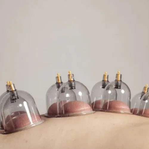 Cupping Therapie tijdens de behandeling bij De Prestige